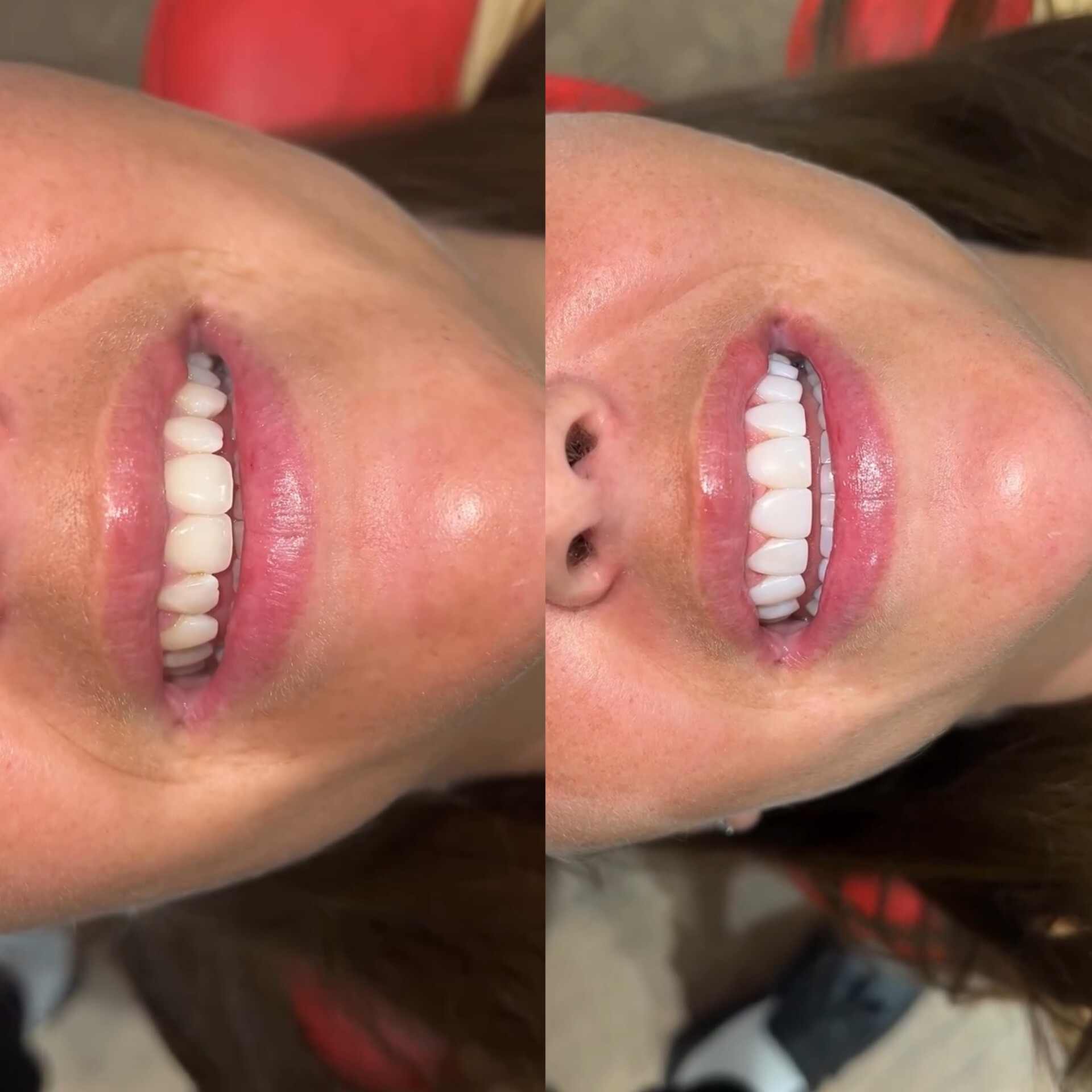 Sourire avec facettes composite